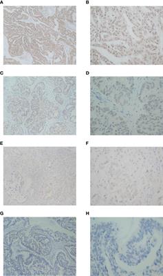 Expression and clinical significance of NCOA5 in epithelial ovarian cancer